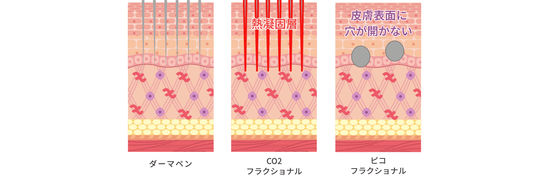 ピコフラクショナル(ニキビ跡・毛穴治療)