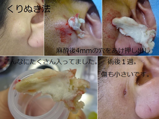 粉瘤の切除 | すずかいとう皮膚科クリニック